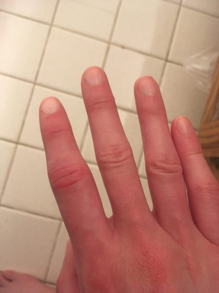 Puffy and swollen index finger