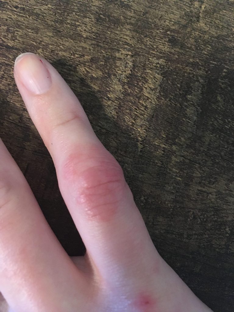 Puffy and swollen pinky finger